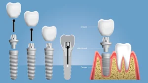 Direkte implantatindsættelse – En moderne løsning efter tandudtrækning